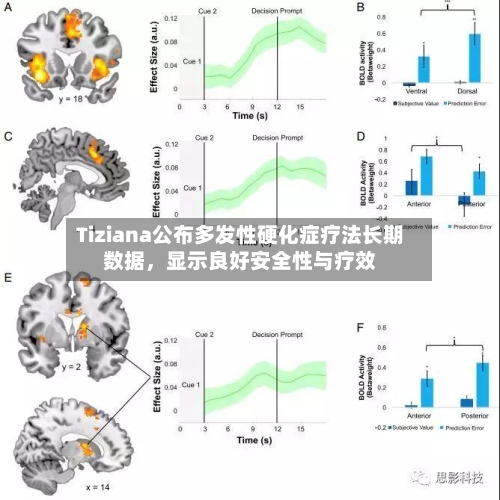 Tiziana公布多发性硬化症疗法长期数据，显示良好安全性与疗效