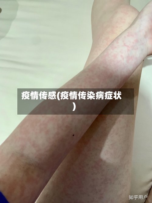 疫情传感(疫情传染病症状)