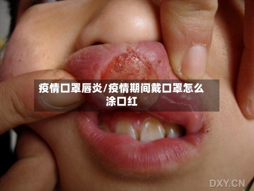 疫情口罩唇炎/疫情期间戴口罩怎么涂口红